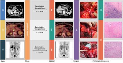 Successful conversion surgery for locally advanced gallbladder cancer after gemcitabine and nab-paclitaxel chemotherapy